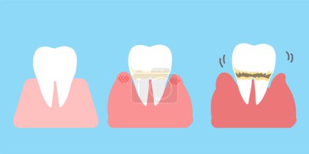 Progresión de la enfermedad periodontal Ilustración simple de los dientes