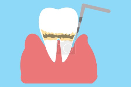 Untersuchung von Parodontitis und Parodontitis beim Zahnarzt