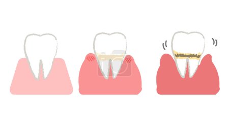Untersuchung von Parodontitis und Parodontitis beim Zahnarzt
