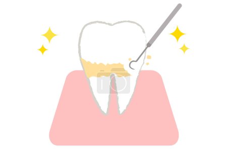 Dents subissant l'enlèvement de la plaque et l'écaillage
