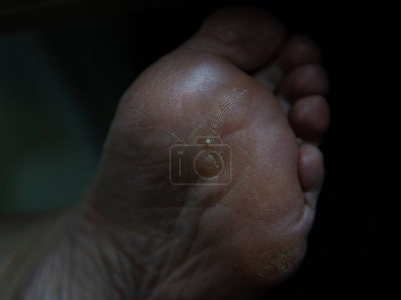 high quality macro shooting callus on a womans foot