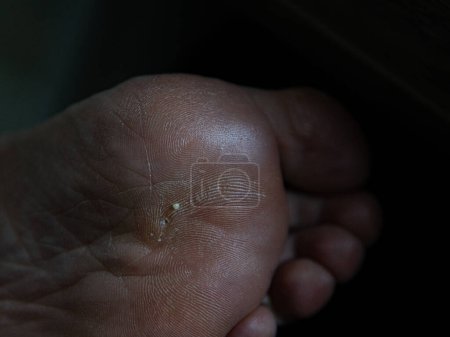 high quality macro shooting callus on a womans foot