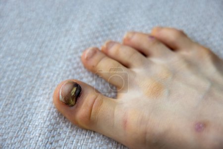 Lesión en el dedo del pie en un niño con una uña traumatizada. Foto de alta calidad