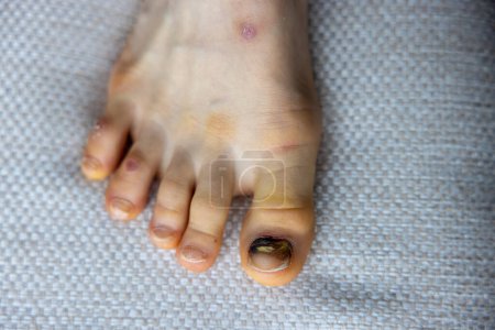 Toe injury in a child with a traumatised toenail . High quality photo