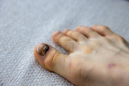 Blessure aux orteils chez un enfant avec un ongle traumatisé. Photo de haute qualité
