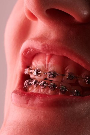Téléchargez les photos : Gros plan de la bouche d'une femme avec des bretelles sur les dents - en image libre de droit