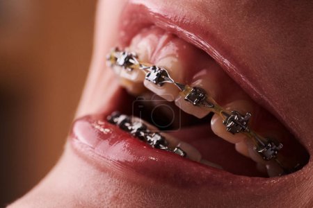 Photo for Close-up of a woman's mouth with braces on her teeth - Royalty Free Image
