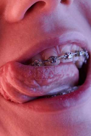 Téléchargez les photos : Gros plan de la bouche d'une femme avec des bretelles sur les dents - en image libre de droit