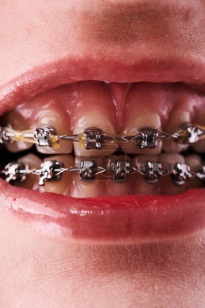 Foto de Primer plano de la boca de una mujer con frenos en los dientes - Imagen libre de derechos