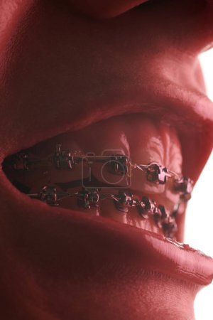 Photo for Close-up of a woman's mouth with braces on her teeth - Royalty Free Image