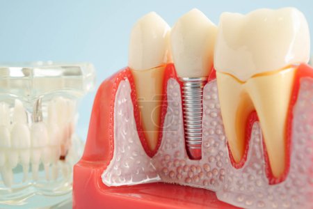 Künstliche Zahnwurzeln Zahnimplantat in Kiefer, Wurzelkanalmodell für Zahnarzt.