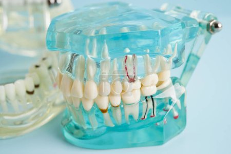 Künstliche Zahnwurzeln Zahnimplantat in Kiefer, Wurzelkanalmodell für Zahnarzt.