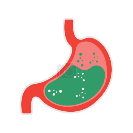 Gastroesophageal reflux disease concept. Human stomach full of gastric acid, cut view. Vector illustration in flat style.