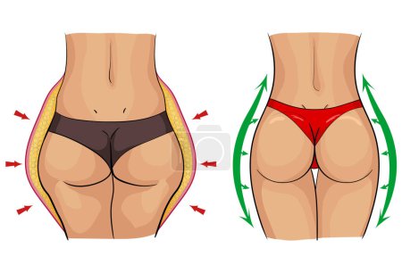 Imágenes del cuerpo de una mujer antes y después de la eliminación de la celulitis con marcas esquemáticas en forma de flechas rojas y verdes. El problema de la celulitis y estrías. 