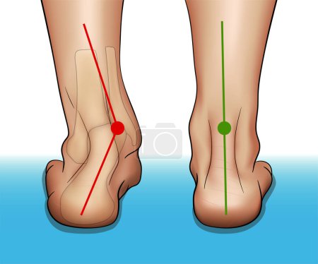 Vektor-Illustration in realistischem Stil, die das medizinische Problem der Fuß- oder Knöchelverkrümmung oder -deformität, der Valgus-Deformität und des Plattfüßproblems darstellt.
