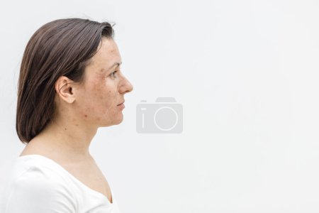 Téléchargez les photos : Photo de la vue latérale de la femme avec la peau endommagée. Concept de soin de la peau. - en image libre de droit
