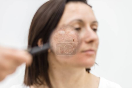 Nahaufnahme Foto einer Frau mit trockener Haut mit Lupe. Konzept der Hautpflege.