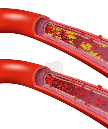 Illustration for Healthy and Cholesterol Blocked Blood Vessels, medical concept on white background, realistic vector illustration - Royalty Free Image