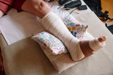 Téléchargez les photos : Pied fracturé avec un bandage fait par un médecin. - en image libre de droit