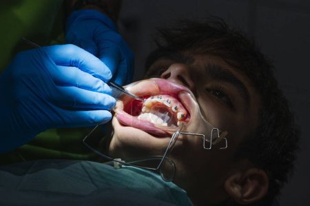 Photo for Teenage at the dental clinic putting bracket to correct teeth - Royalty Free Image