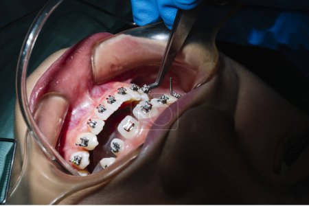 Téléchargez les photos : Adolescence à la clinique dentaire mettant support pour corriger les dents - en image libre de droit