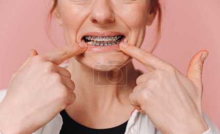 Foto de Primer plano femenino señalando los dedos a los soportes metálicos sobre fondo rosa, concepto de ortodoncia - Imagen libre de derechos