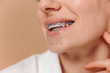 Nahaufnahme einer Frau mit Zahnspange auf beigem Hintergrund
