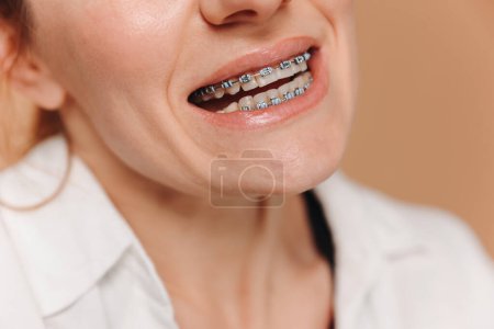 Nahaufnahme einer Frau mit Zahnspange auf beigem Hintergrund