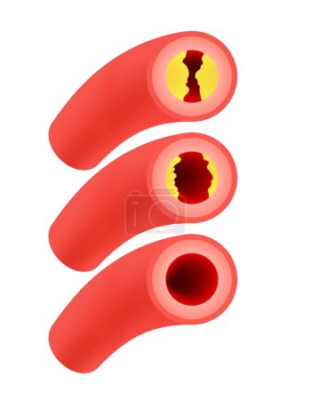 Illustration for Coronary Artery Disease info graphic. Blocked artery, heart awareness concept. Illustration - Royalty Free Image