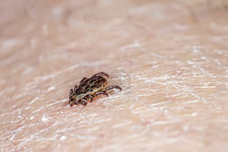 garrapata cavando en la piel humana primer plano de una. temporada de garrapatas y el concepto de enfermedad de Lyme.
