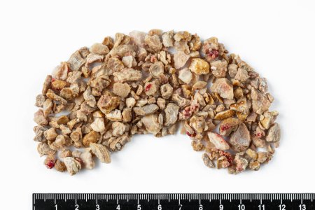 Photo for Kidney stones. Stones were removed from the patient's kidneys - Royalty Free Image