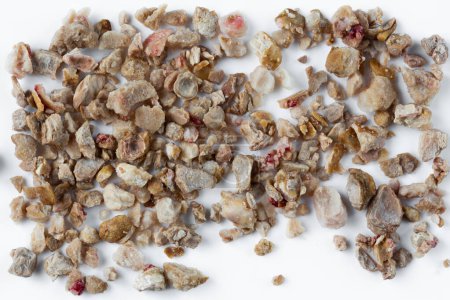 Kidney stones. Stones were removed from the patient's kidneys