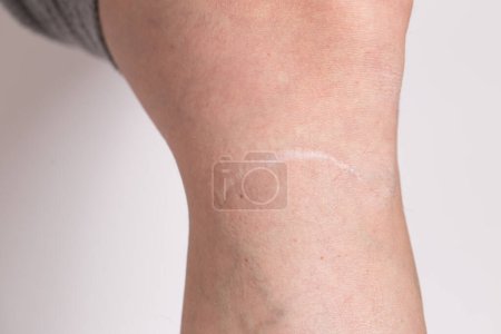 Foto de Cicatriz en un primer plano de piernas de chicas. Venas varicosas de la lesión en la pierna sobre un fondo blanco aislado. - Imagen libre de derechos