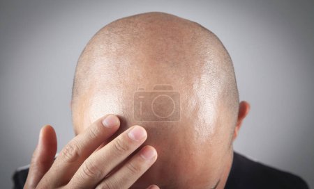 Foto de Hombre calvo caucásico. Antes del trasplante de cabello - Imagen libre de derechos