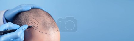 Téléchargez les photos : Patient souffrant de perte de cheveux en consultation avec un médecin. Espace pour votre texte - en image libre de droit