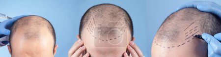 Téléchargez les photos : Patient souffrant de perte de cheveux en consultation avec un médecin. - en image libre de droit