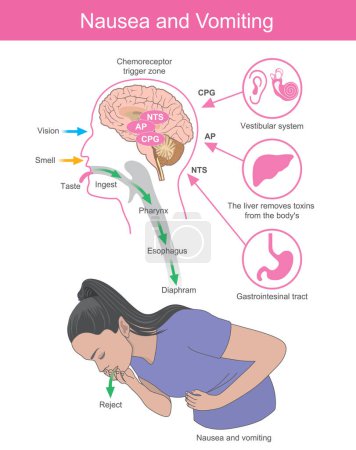 Ilustración de Náuseas y vómitos. Una mujer con síntomas náuseas y vómitos que es el efecto de los procesos cerebrales - Imagen libre de derechos