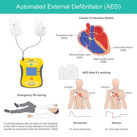 Défibrillateur externe automatisé. Il s'agit d'un dispositif électronique de survie qui reconnaît la fibrillation ventriculaire et d'autres dysrythmies et délivre un choc électrique au bon moment