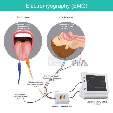 Illustration for Electromyography. A technique medical use for assessing and recording the electrical activity produced by muscles - Royalty Free Image