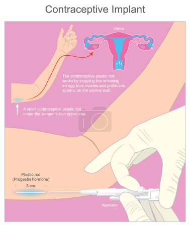 Illustration for Contraceptive Implant. A small contraceptive plastic rod under the woman skin upper arm - Royalty Free Image
