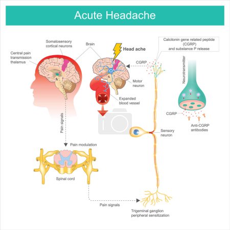 Illustration for Acute Headache. Diagram learning The Acute Headache as a result a process of the brain and consequences expanded the blood vessel - Royalty Free Image