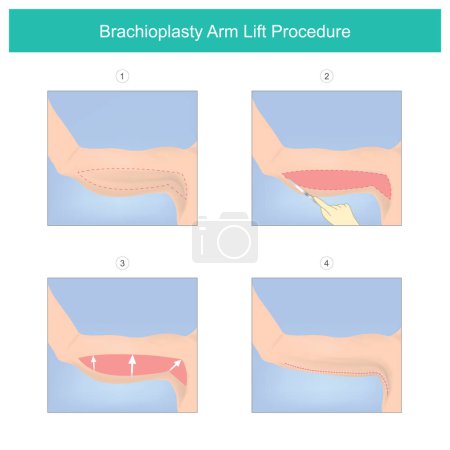 Brachioplastik Armheben Verfahren. Bei medizinischen Prozessen werden überschüssige Haut und Fett zwischen Achselhöhle und Ellbogen entfernt. die restliche Haut wird wieder über die neu positionierten Konturen gelegt