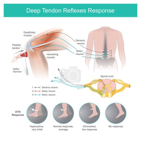 Ilustración de Deep Tendon Reflejos Respuesta. El médico examina los sistemas nerviosos mediante un martillo reflectante que golpea el tendón en el área de la rodilla y hace que la espinilla se mueva automáticamente. - Imagen libre de derechos