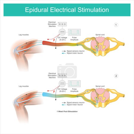 Estimulación eléctrica epidural. Síntoma de dolor muscular en el área de las piernas y tratamiento mediante estimulación eléctrica en la piel y luego pasó los músculos y nervios de las piernas
