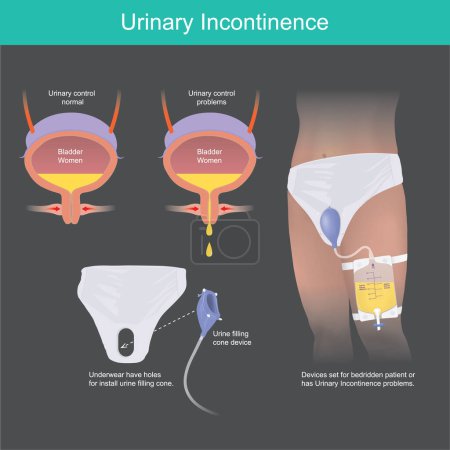 Ilustración de Incontinencia urinaria. Dispositivo de cono de llenado de orina para pacientes postrados en cama o tiene problemas de incontinencia urinaria - Imagen libre de derechos