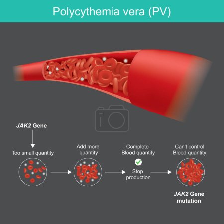 Illustration for Polycythemia vera. Too much red blood cells have in blood vessel and diagram explain blood disorders - Royalty Free Image