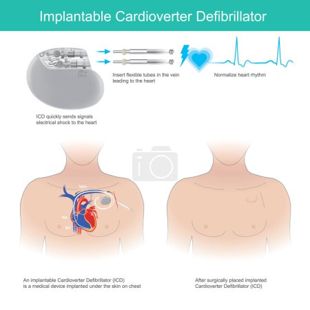 Ilustración de Desfibrilador cardioversor implantable. Herramienta médica implantada debajo de la piel para enviar rápidamente señales de choque eléctrico al corazón. - Imagen libre de derechos