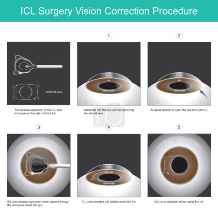 Illustration for ICL Surgery Vision Correction Procedure. A new eye lens that can be implanted into the eye without removing the natural lens - Royalty Free Image