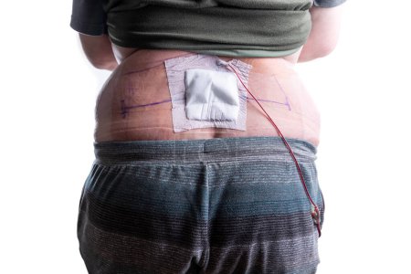 Back view of a person with a large spine bandage and drain tubing post surgery