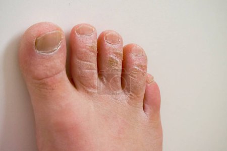 Foto de Piel muerta en los dedos de los pies, dedos de los pies cercanos con enfermedad fúngica, - Imagen libre de derechos